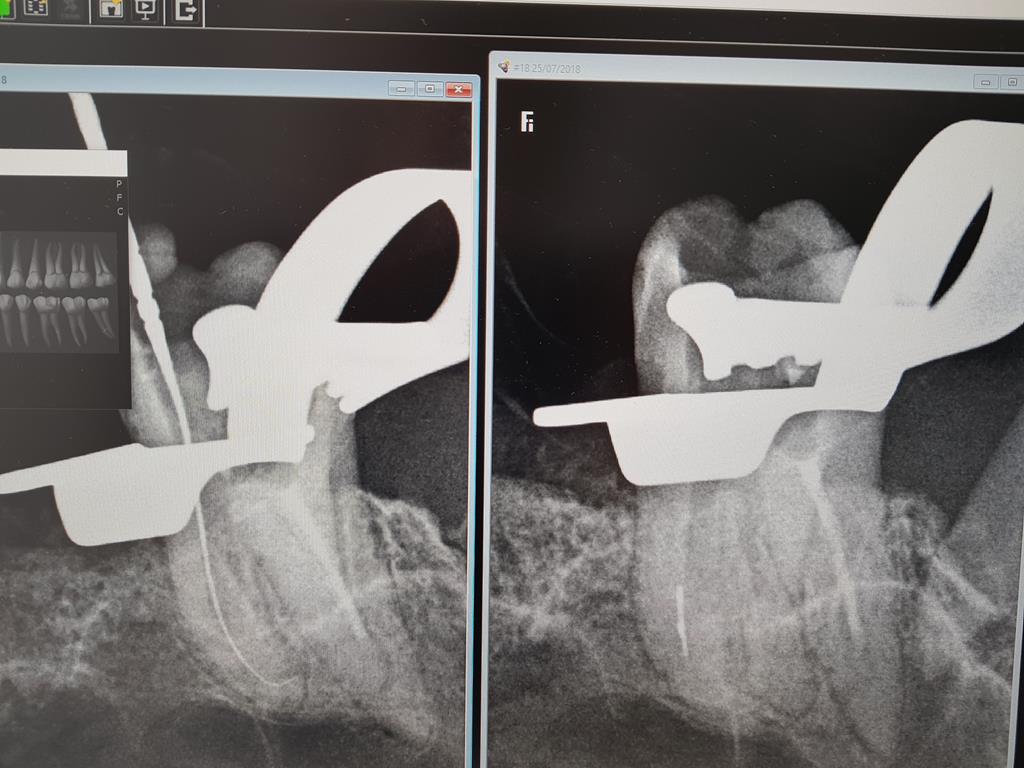 leczneie-kanalowe-1 endodoncja
